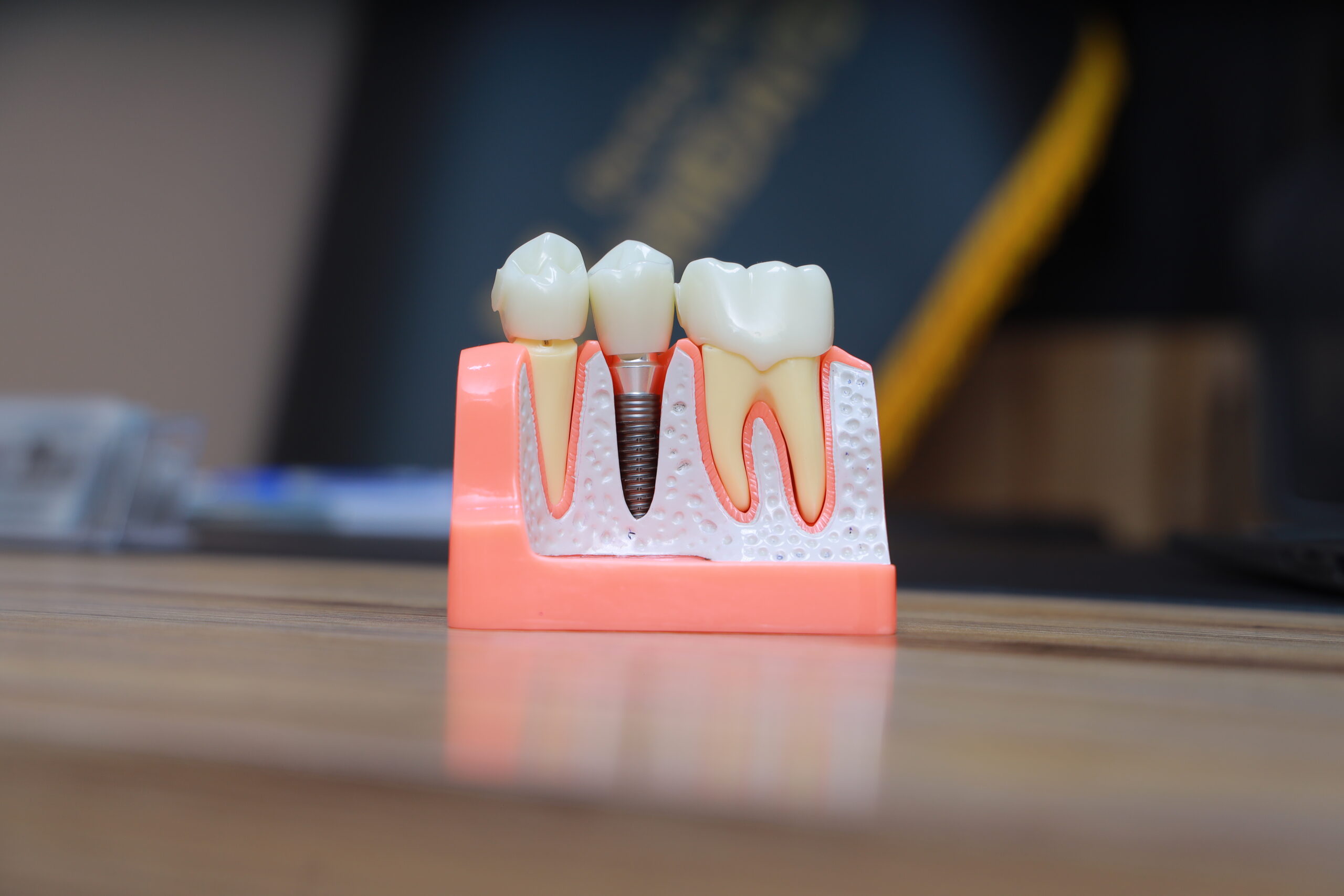 Prosthodontics and restorative dentistry model at Hamdard Dental Clinic in Kabul