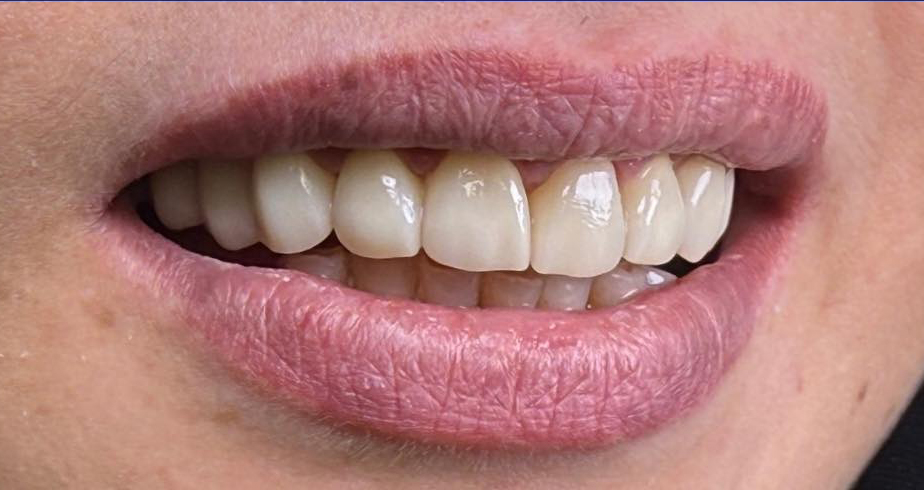 Natural-looking smile improvement with cosmetic dentistry and orthodontics at Hamdard Dental Clinic in Kabul
