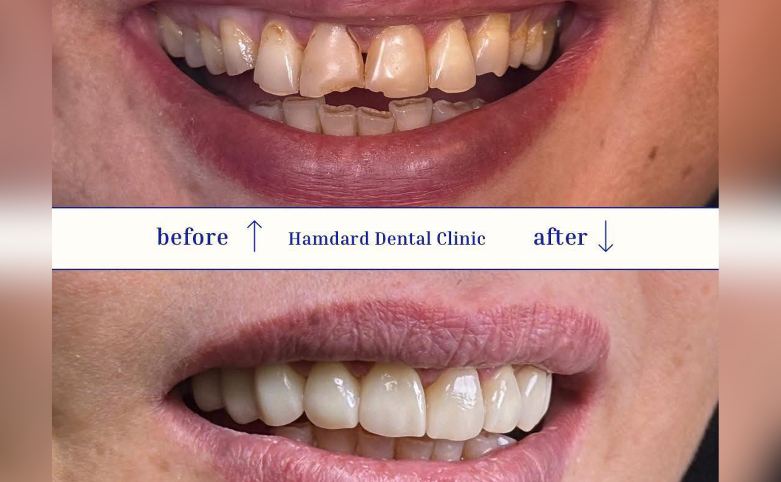 Natural-looking smile improvement with cosmetic dentistry and orthodontics at Hamdard Dental Clinic in Kabul