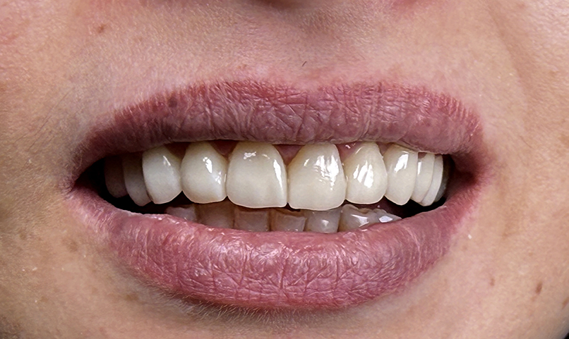 Anterior teeth restoration after treatment at Hamdard Dental Clinic in Kabul