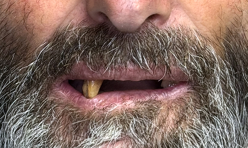 Teeth before complete denture treatment in Kabul dental clinic