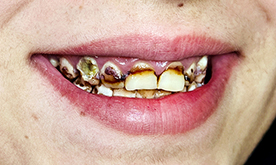 Enamel hypoplasia before treatment at Hamdard Dental Clinic in Kabul